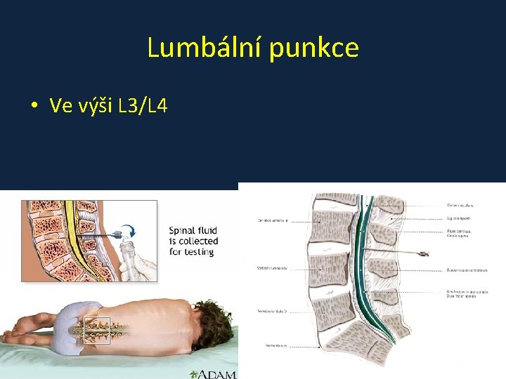 Lumbální punkce • Ve výši L 3/L 4 Lumbální punkce • Ve výši L 3/L 4