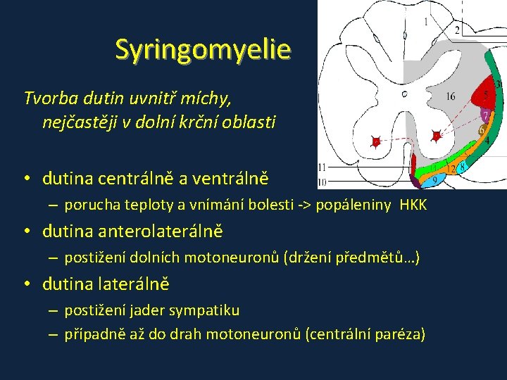 Syringomyelie Tvorba dutin uvnitř míchy, nejčastěji v dolní krční oblasti • dutina centrálně a Syringomyelie Tvorba dutin uvnitř míchy, nejčastěji v dolní krční oblasti • dutina centrálně a