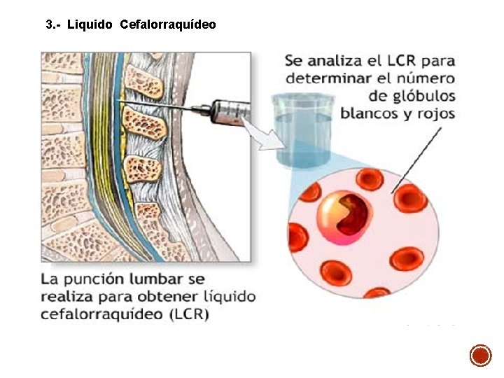 3. - Liquido Cefalorraquídeo 3. - Liquido Cefalorraquídeo