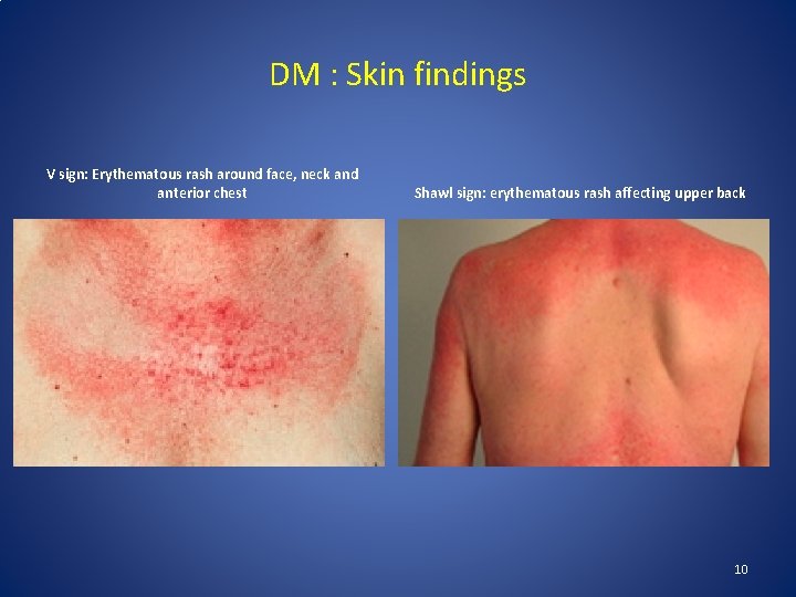 DM : Skin findings V sign: Erythematous rash around face, neck and anterior chest