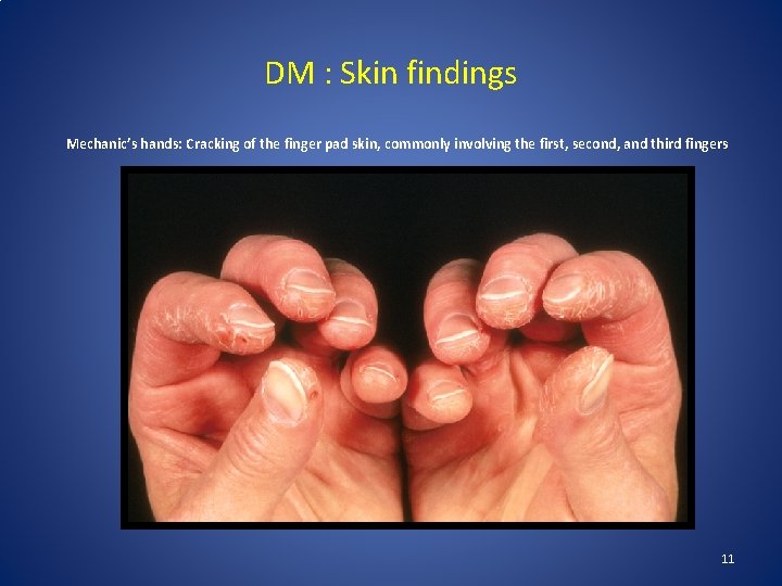 DM : Skin findings Mechanic’s hands: Cracking of the finger pad skin, commonly involving