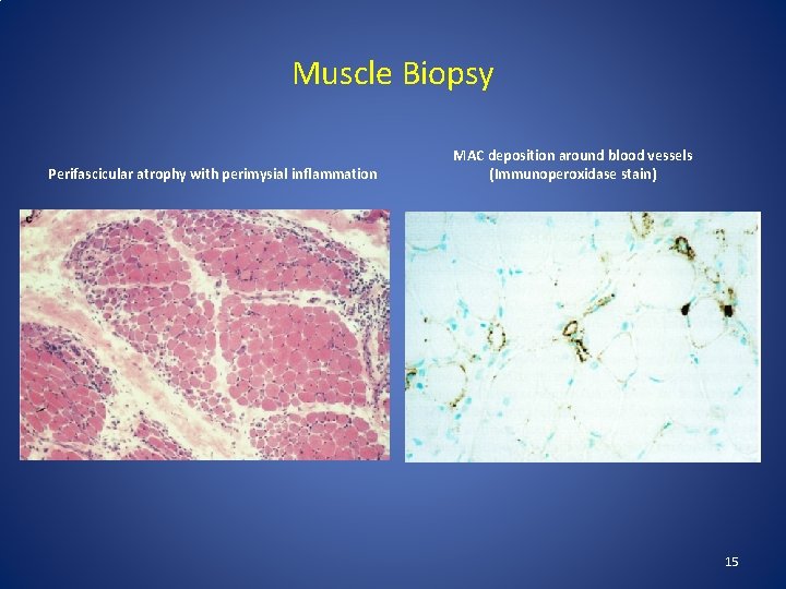 Muscle Biopsy Perifascicular atrophy with perimysial inflammation MAC deposition around blood vessels (Immunoperoxidase stain)