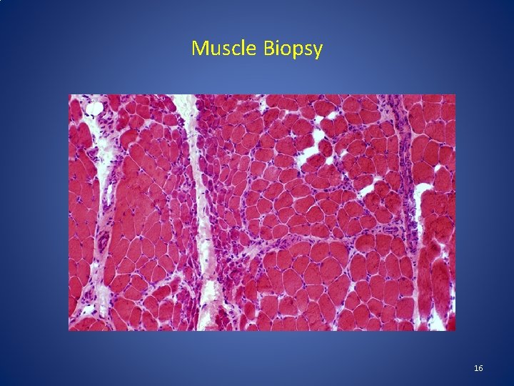 Muscle Biopsy 16 