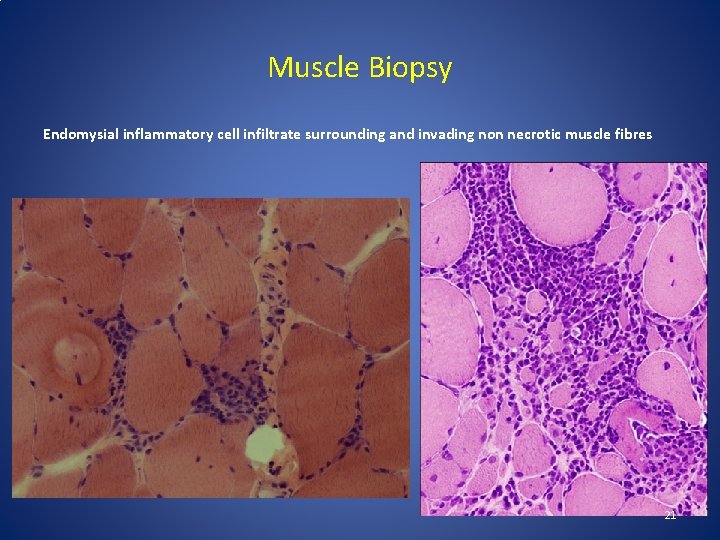 Muscle Biopsy Endomysial inflammatory cell infiltrate surrounding and invading non necrotic muscle fibres 21