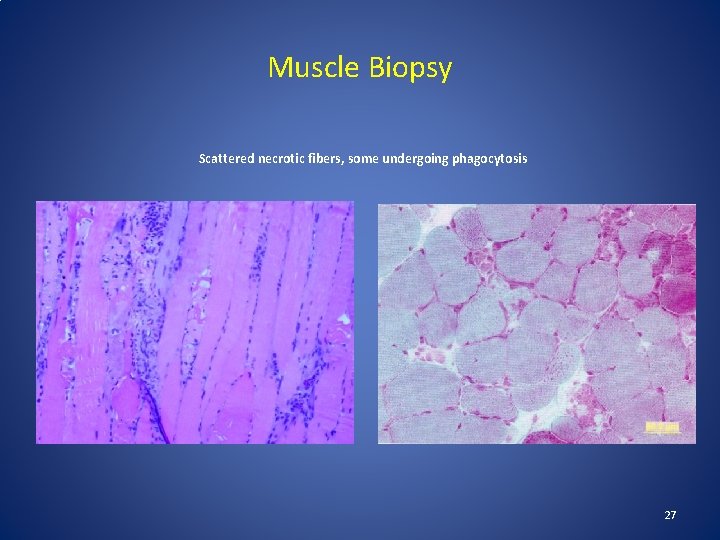 Muscle Biopsy Scattered necrotic fibers, some undergoing phagocytosis 27 