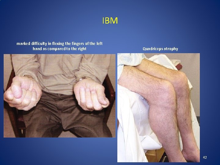 IBM marked difficulty in flexing the fingers of the left hand as compared to