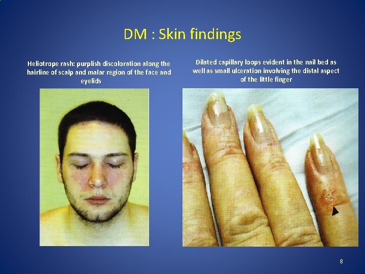 DM : Skin findings Heliotrope rash: purplish discoloration along the hairline of scalp and