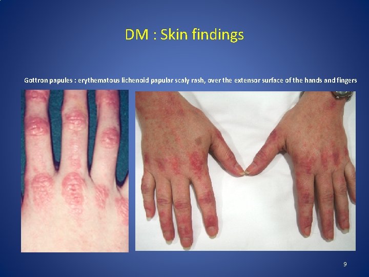 DM : Skin findings Gottron papules : erythematous lichenoid papular scaly rash, over the DM : Skin findings Gottron papules : erythematous lichenoid papular scaly rash, over the