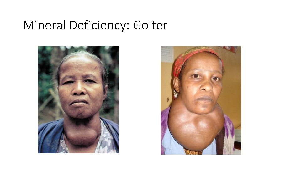 Mineral Deficiency: Goiter 