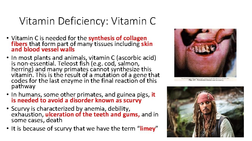 Vitamin Deficiency: Vitamin C • Vitamin C is needed for the synthesis of collagen