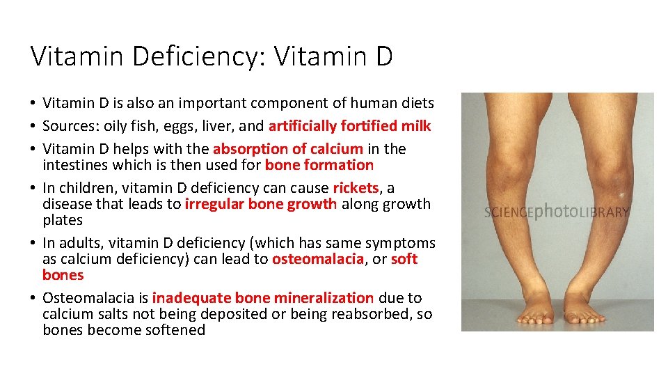 Vitamin Deficiency: Vitamin D • Vitamin D is also an important component of human