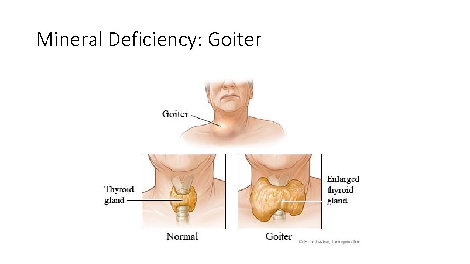 Mineral Deficiency: Goiter 