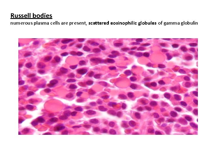 Russell bodies numerous plasma cells are present, scattered eosinophilic globules of gamma globulin 