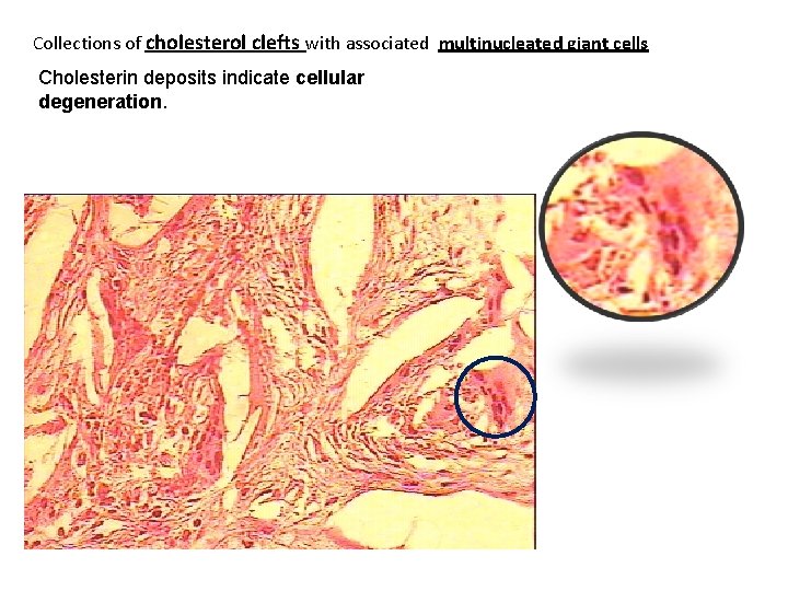 Collections of cholesterol clefts with associated multinucleated giant cells Cholesterin deposits indicate cellular degeneration.