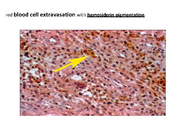 red blood cell extravasation with hemosiderin pigmentation 