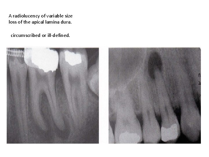 A radiolucency of variable size loss of the apical lamina dura. circumscribed or ill-defined.