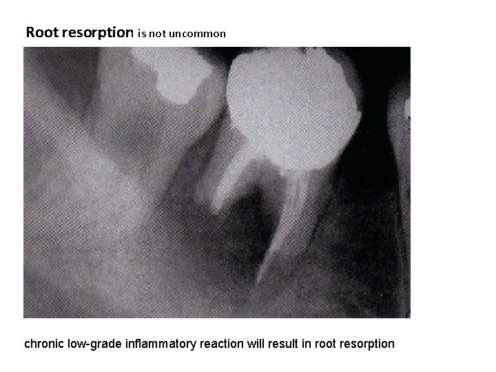 Root resorption is not uncommon chronic low-grade inflammatory reaction will result in root resorption