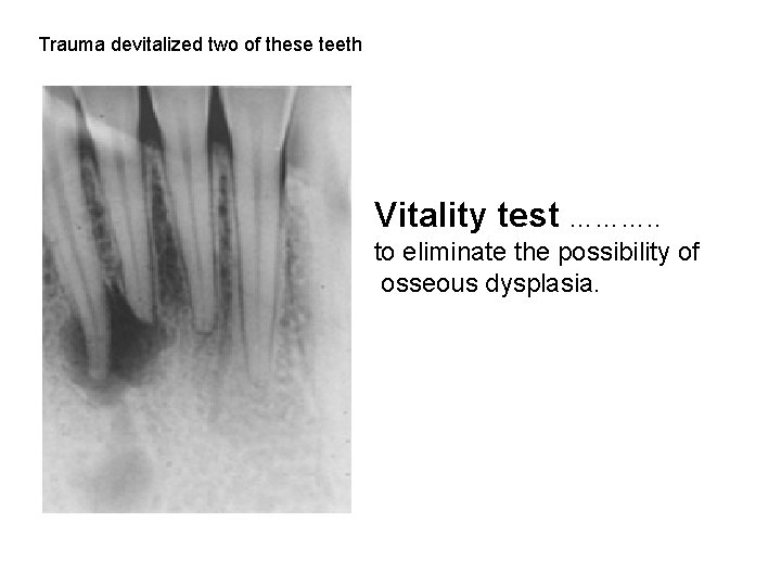 Trauma devitalized two of these teeth Vitality test ………. . to eliminate the possibility