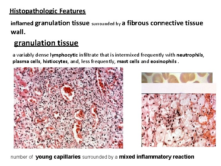 Histopathologic Features inflamed granulation tissue surrounded by a fibrous connective tissue wall. granulation tissue