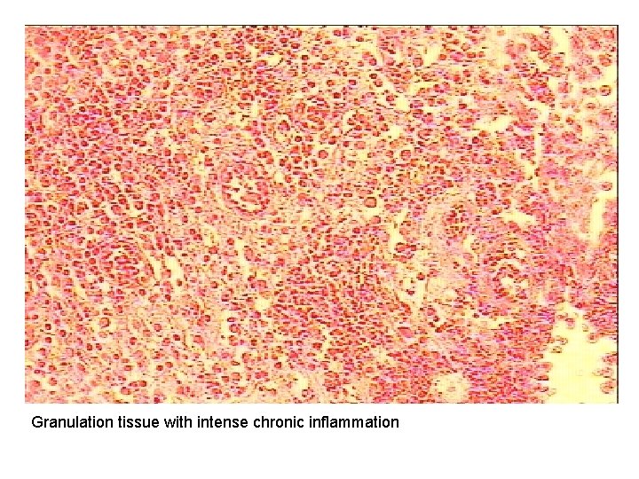 Granulation tissue with intense chronic inflammation 