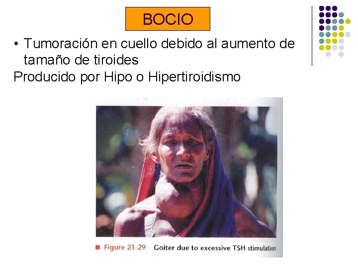 BOCIO • Tumoración en cuello debido al aumento de tamaño de tiroides Producido por