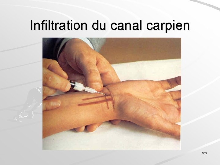 Infiltration du canal carpien 103 