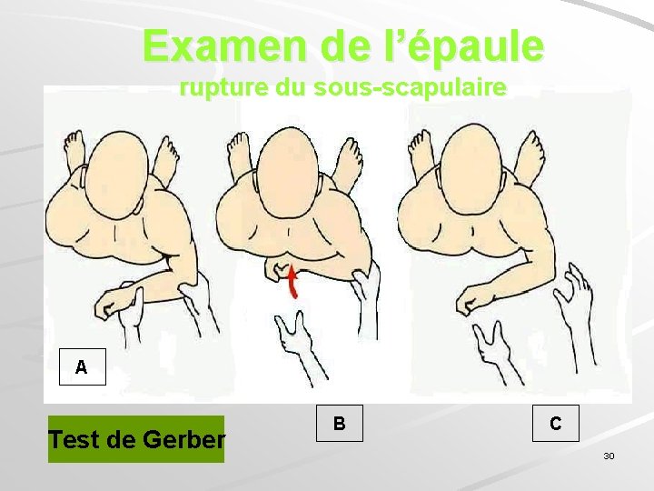 Examen de l’épaule rupture du sous-scapulaire A Test de Gerber B C 30 
