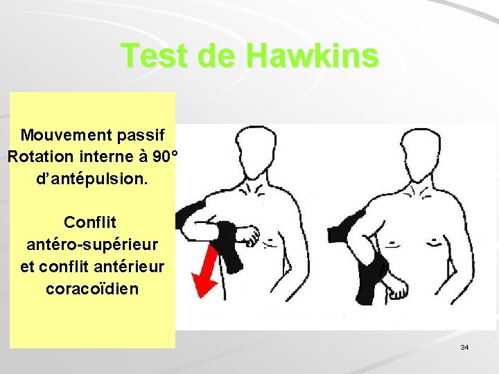 Test de Hawkins Mouvement passif Rotation interne à 90° d’antépulsion. Conflit antéro-supérieur et conflit