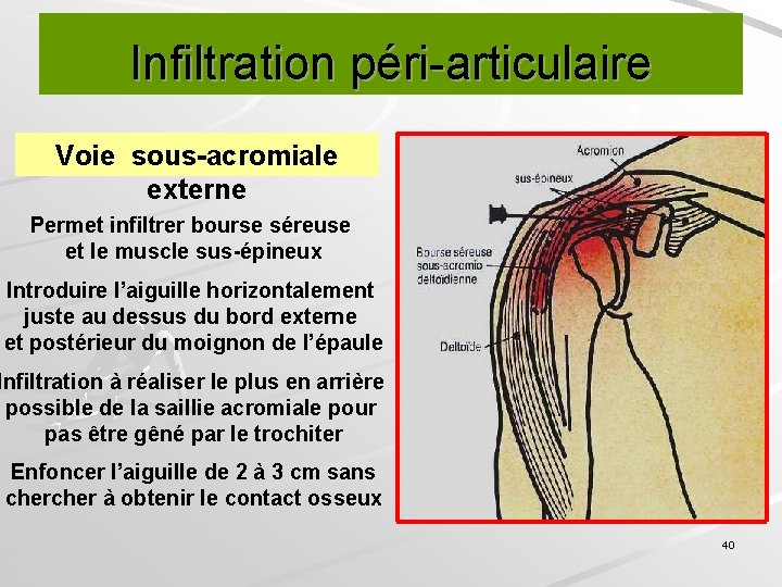 Infiltration péri-articulaire Voie sous-acromiale externe Permet infiltrer bourse séreuse et le muscle sus-épineux Introduire