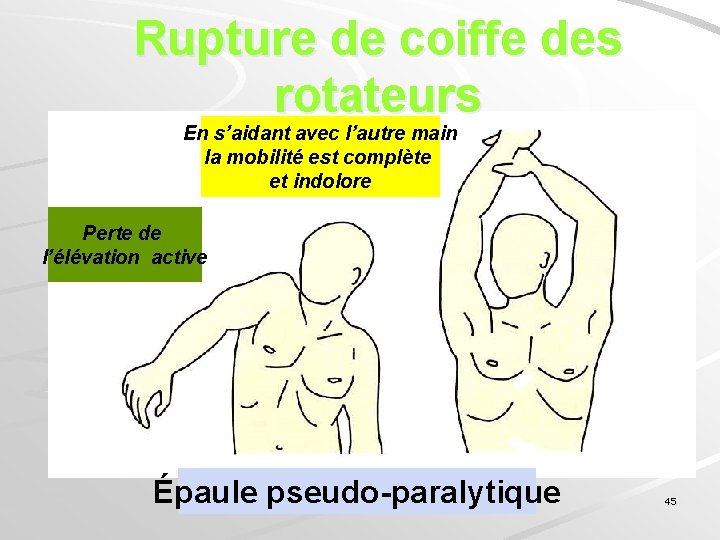 Rupture de coiffe des rotateurs En s’aidant avec l’autre main la mobilité est complète