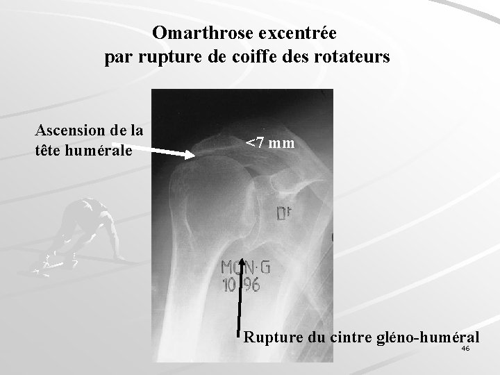 Omarthrose excentrée par rupture de coiffe des rotateurs Ascension de la tête humérale <7