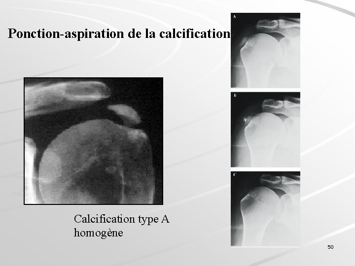 Ponction-aspiration de la calcification Calcification type A homogène 50 