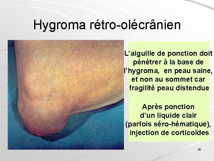 Hygroma rétro-olécrânien L’aiguille de ponction doit pénétrer à la base de l’hygroma, en peau