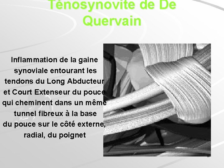 Ténosynovite de De Quervain Inflammation de la gaine synoviale entourant les tendons du Long