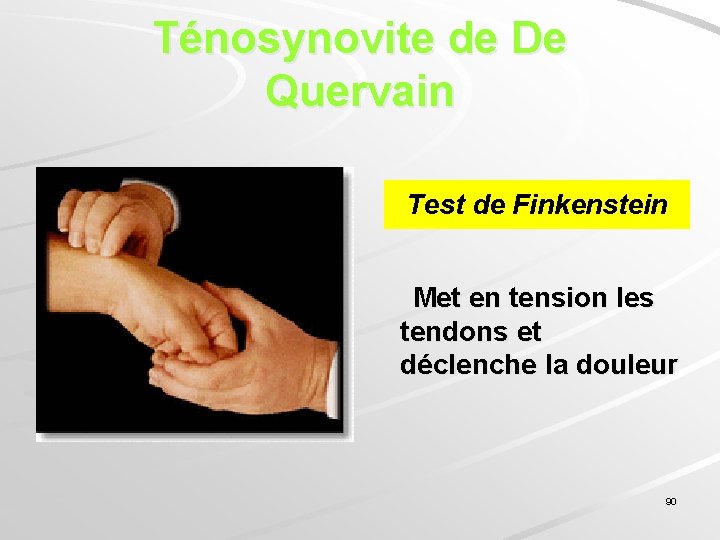 Ténosynovite de De Quervain Test de Finkenstein Met en tension les tendons et déclenche