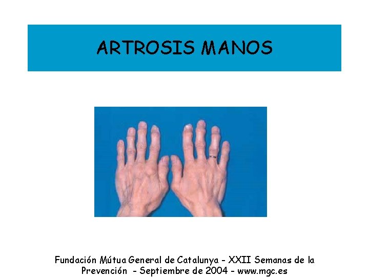 ARTROSIS MANOS Fundación Mútua General de Catalunya - XXII Semanas de la Prevención -