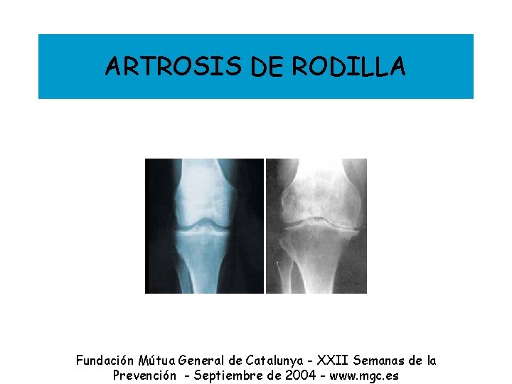 ARTROSIS DE RODILLA Fundación Mútua General de Catalunya - XXII Semanas de la Prevención