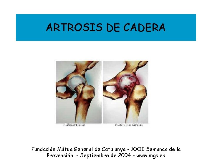 ARTROSIS DE CADERA Fundación Mútua General de Catalunya - XXII Semanas de la Prevención