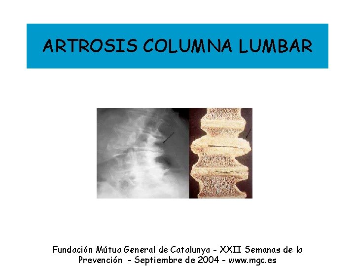 ARTROSIS COLUMNA LUMBAR Fundación Mútua General de Catalunya - XXII Semanas de la Prevención