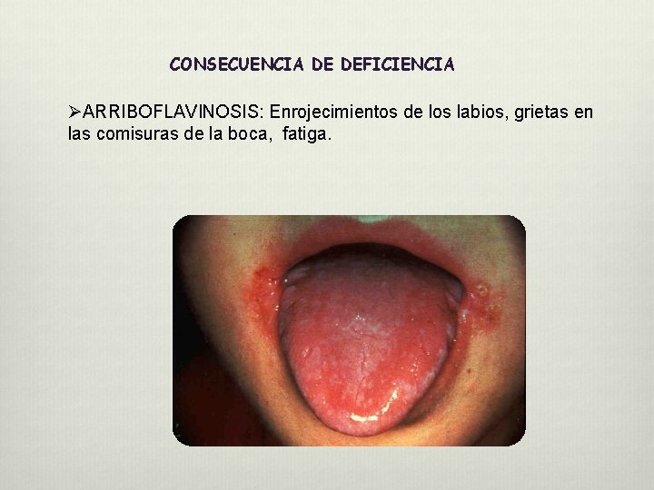 CONSECUENCIA DE DEFICIENCIA ØARRIBOFLAVINOSIS: Enrojecimientos de los labios, grietas en las comisuras de la CONSECUENCIA DE DEFICIENCIA ØARRIBOFLAVINOSIS: Enrojecimientos de los labios, grietas en las comisuras de la