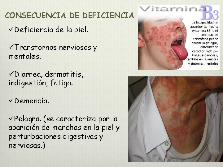 CONSECUENCIA DE DEFICIENCIA üDeficiencia de la piel. üTranstornos nerviosos y mentales. üDiarrea, dermatitis, indigestión, CONSECUENCIA DE DEFICIENCIA üDeficiencia de la piel. üTranstornos nerviosos y mentales. üDiarrea, dermatitis, indigestión,