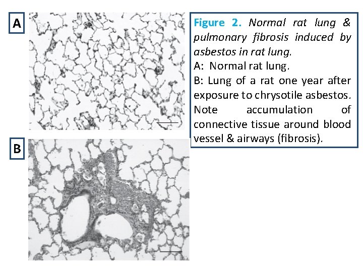 A B Figure 2. Normal rat lung & pulmonary ﬁbrosis induced by asbestos in