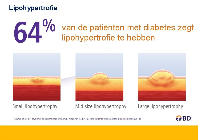 Lipohypertrofie van de patiënten met diabetes zegt lipohypertrofie te hebben 