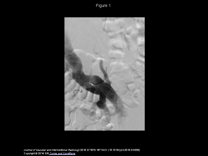 Figure 1 Journal of Vascular and Interventional Radiology 2016 271870 -1871 DOI: (10. 1016/j.