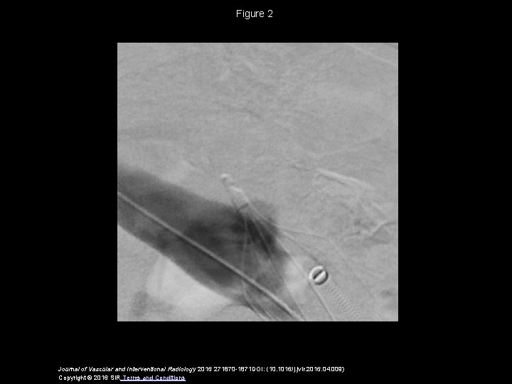 Figure 2 Journal of Vascular and Interventional Radiology 2016 271870 -1871 DOI: (10. 1016/j.