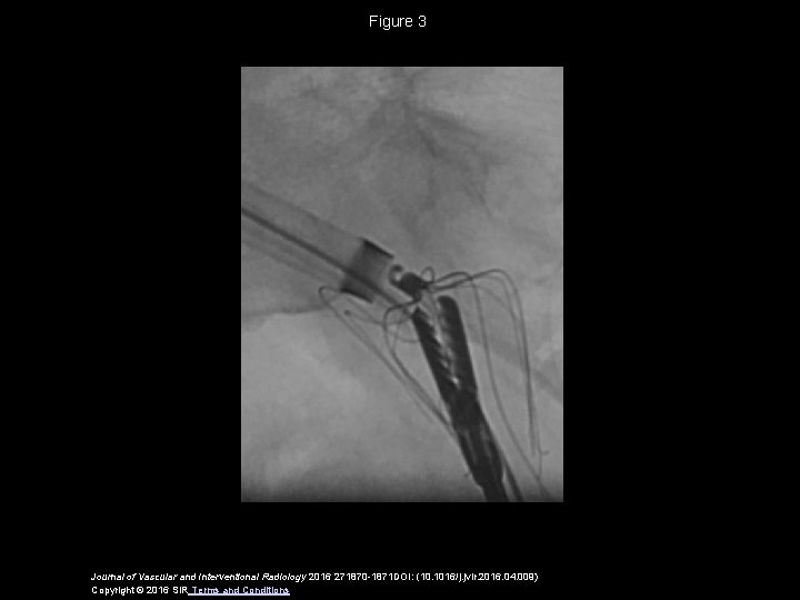 Figure 3 Journal of Vascular and Interventional Radiology 2016 271870 -1871 DOI: (10. 1016/j.