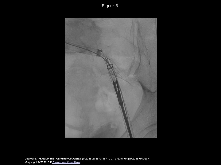 Figure 5 Journal of Vascular and Interventional Radiology 2016 271870 -1871 DOI: (10. 1016/j.