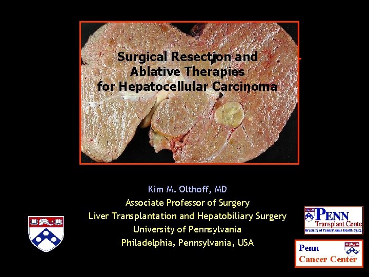 Surgical Resection and Ablative Therapies for Hepatocellular Carcinoma Kim M. Olthoff, MD Associate Professor