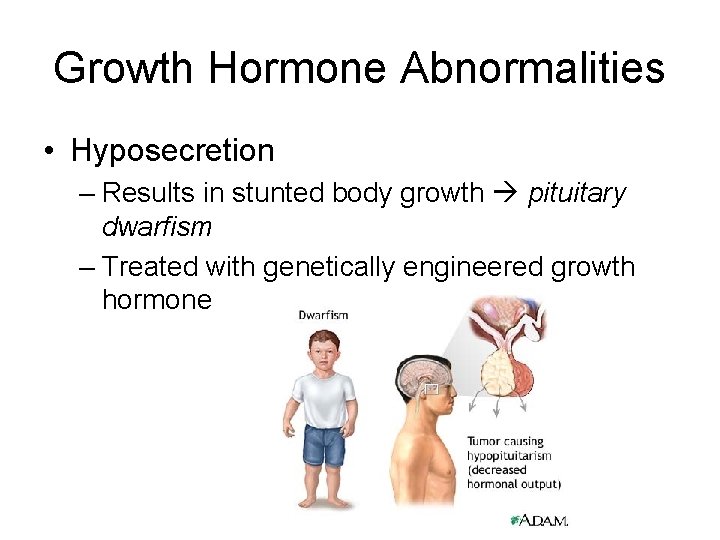 Growth Hormone Abnormalities • Hyposecretion – Results in stunted body growth pituitary dwarfism –
