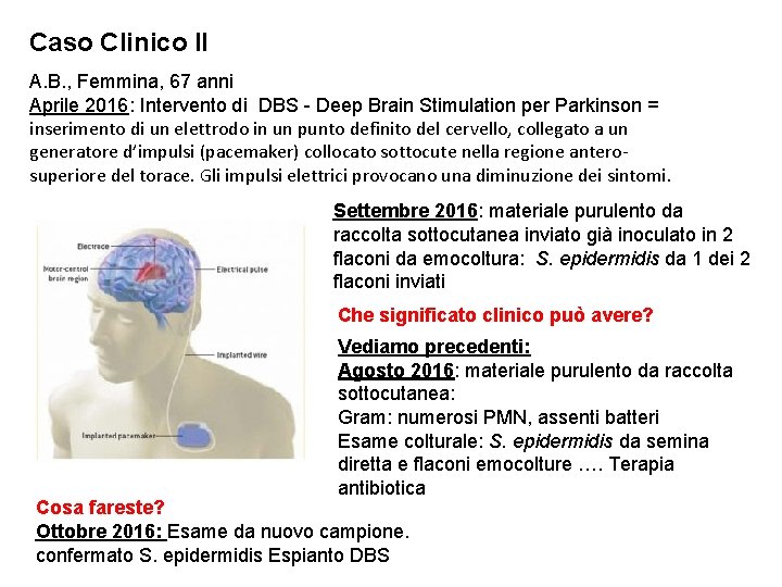 Caso Clinico II A. B. , Femmina, 67 anni Aprile 2016: Intervento di DBS